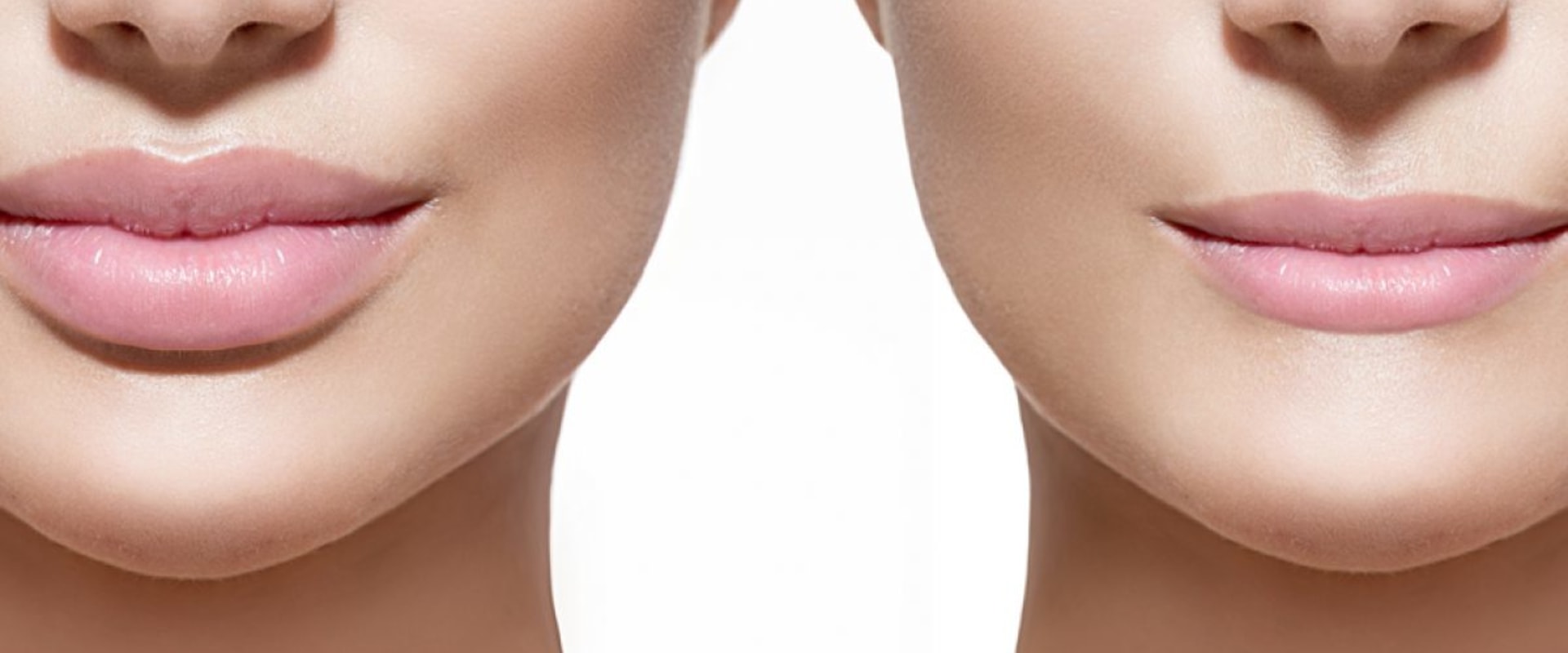 How Long Does Swelling Last After Restylane Lip Injections?