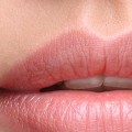 When Does Restylane Settle? A Comprehensive Guide