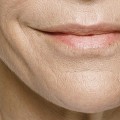 Who owns restylane?