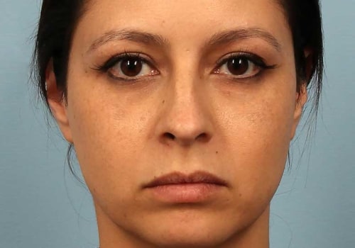 How Long Does Botox and Restylane Last? A Comprehensive Guide