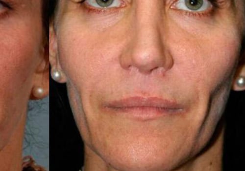 What are Restylane Injections and How Can They Help You Look Younger?