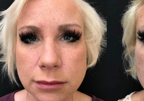Restylane Lyft: Who Makes It and What Are Its Benefits?