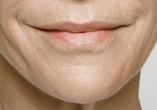 Who owns restylane?